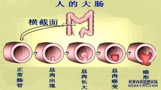 有痔疮突然一直流血