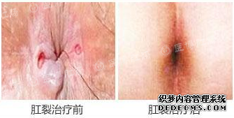 腹泻便血