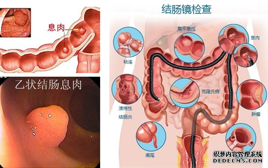 痔疮是什么原因造成的